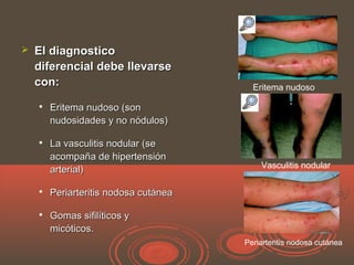  El diagnosticoEl diagnostico
diferencial debe llevarsediferencial debe llevarse
con:con:

Eritema nudoso (sonEritema nudoso (son
nudosidades y no nódulos)nudosidades y no nódulos)

La vasculitis nodular (seLa vasculitis nodular (se
acompaña de hipertensiónacompaña de hipertensión
arterial)arterial)

Periarteritis nodosa cutáneaPeriarteritis nodosa cutánea

Gomas sifilíticos yGomas sifilíticos y
micóticos.micóticos.
Eritema nudoso
Vasculitis nodular
Periarteritis nodosa cutánea
 