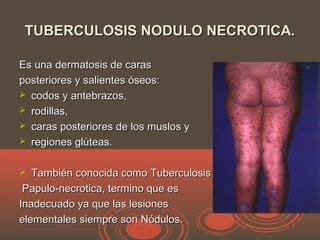 TUBERCULOSIS NODULO NECROTICA.TUBERCULOSIS NODULO NECROTICA.
Es una dermatosis de carasEs una dermatosis de caras
posteriores y salientes óseos:posteriores y salientes óseos:
 codos y antebrazos,codos y antebrazos,
 rodillas,rodillas,
 caras posteriores de los muslos ycaras posteriores de los muslos y
 regiones glúteas.regiones glúteas.
 También conocida como TuberculosisTambién conocida como Tuberculosis
Papulo-necrotica, termino que esPapulo-necrotica, termino que es
Inadecuado ya que las lesionesInadecuado ya que las lesiones
elementales siempre son Nódulos.elementales siempre son Nódulos.
 