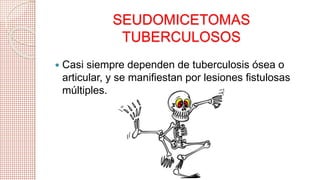 SEUDOMICETOMAS 
TUBERCULOSOS 
 Casi siempre dependen de tuberculosis ósea o 
articular, y se manifiestan por lesiones fistulosas 
múltiples. 
 