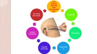 Las 
formas 
clínicas 
más 
frecuentes 
son: 
la luposa 
Verrugosa 
Colicuativ 
a 
nodular 
profunda 
las otras 
son raras. 
nódulo 
necrótical 
 