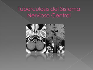 Tuberculosis del sistema nervioso central