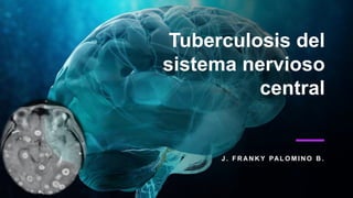 Tuberculosis del
sistema nervioso
central
J . F R AN K Y PAL O M I N O B .
 
