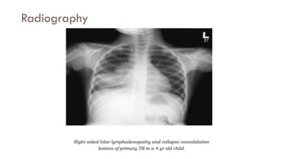 33
Radiography
Right-sided hilar lymphadenopathy and collapse consolidation
lesions of primary TB in a 4 yr old child.
 