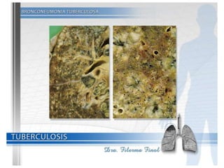 Tuberculosis Dra. Filerma Finol. 2013