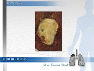 Tuberculosis Dra. Filerma Finol. 2013