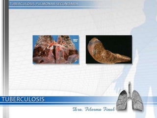 Tuberculosis Dra. Filerma Finol. 2013