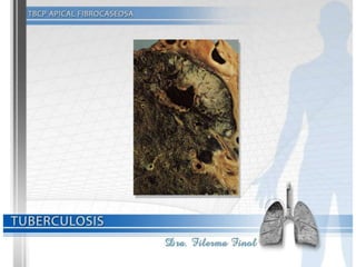 Tuberculosis Dra. Filerma Finol. 2013