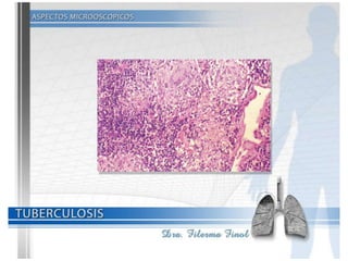 Tuberculosis Dra. Filerma Finol. 2013