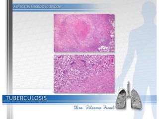 Tuberculosis Dra. Filerma Finol. 2013