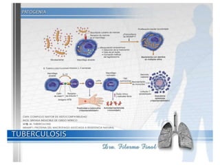 Tuberculosis Dra. Filerma Finol. 2013