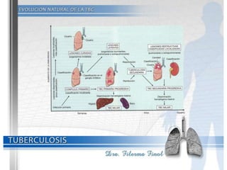 Tuberculosis Dra. Filerma Finol. 2013