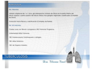 Tuberculosis Dra. Filerma Finol. 2013