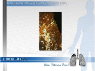 Tuberculosis Dra. Filerma Finol. 2013