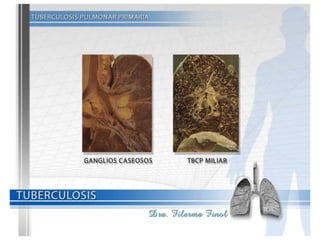 Tuberculosis Dra. Filerma Finol. 2013