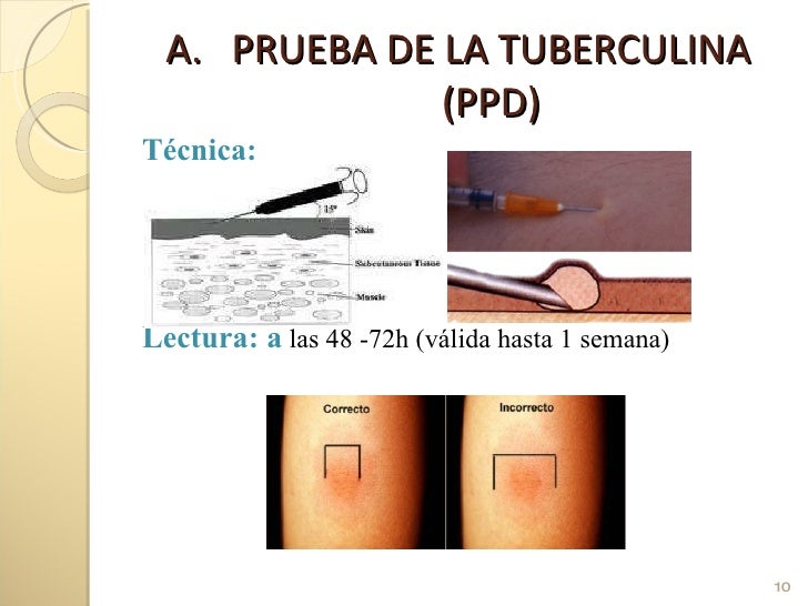 Tuberculosis diagnóstico Tuberculosis diagnóstico