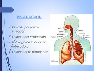 PRESENTACION:
 Lesiones por primo-
infección
 Lesiones por reinfección
 Patología de la caverna
tuberculosa
 Lesiones Extra pulmonares
 