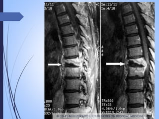 Tuberculosis en edad pediatrica