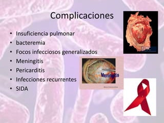 Complicaciones
• Insuficiencia pulmonar
• bacteremia
• Focos infecciosos generalizados
• Meningitis
• Pericarditis
• Infecciones recurrentes
• SIDA
 