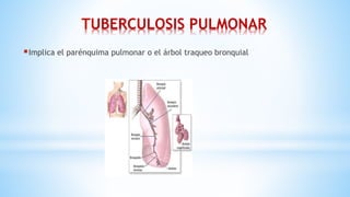 TUBERCULOSIS PULMONAR
Implica el parénquima pulmonar o el árbol traqueo bronquial
 