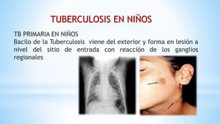 TB PRIMARIA EN NIÑOS
Bacilo de la Tuberculosis viene del exterior y forma en lesión a
nivel del sitio de entrada con reacción de los ganglios
regionales
TUBERCULOSIS EN NIÑOS
 