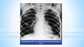 Complejo de Ghon con calcificación parenquimatosa e
hiliar
 