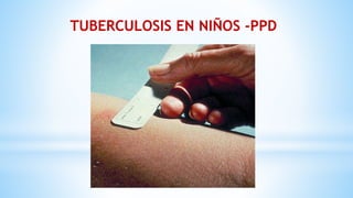TUBERCULOSIS EN NIÑOS -PPD
 