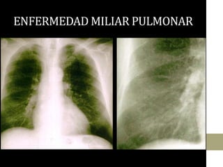 Tuberculosis extrapulmonar y miliar