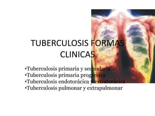 TUBERCULOSIS FORMAS
CLINICAS
•Tuberculosis primaria y secundaria
•Tuberculosis primaria progresiva
•Tuberculosis endotorácica y extratorácica
•Tuberculosis pulmonar y extrapulmonar
 