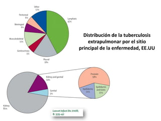 Distribución de la tuberculosis
    extrapulmonar por el sitio
principal de la enfermedad, EE.UU
 