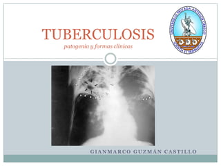 TUBERCULOSIS
  patogenia y formas clínicas




            GIANMARCO GUZMÁN CASTILLO
 