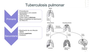Tuberculosis pulmonar
Primaria
• Primoinfección
• Asintomática o con curación
espontanea
• Lesión de Ghon
• Lóbulo medio e inferiores
• Mayor probabilidad de diseminación
en niños e IC
Secundaria
• Reactivación de una infección
latente
• Lóbulos superiores
• Cavitación
 