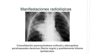 Manifestaciones radiológicas
Consolidación parenquimatosa unifocal y adenopatías
paratraqueales derechas (flecha negra) y posiblemente hiliares
ipsilaterales.
 