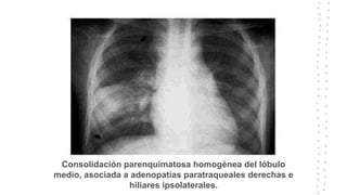 Consolidación parenquimatosa homogénea del lóbulo
medio, asociada a adenopatías paratraqueales derechas e
hiliares ipsolaterales.
 