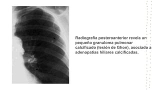 Radiografía posteroanterior revela un
pequeño granuloma pulmonar
calcificado (lesión de Ghon), asociado a
adenopatías hiliares calcificadas.
 