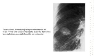 Tuberculoma. Una radiografía posteroanterior de
tórax revela una opacidad derecha ovalada, de bordes
bien definidos, con calcificación en su interior.
 