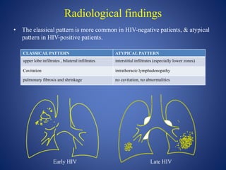 Radiological findings
• The classical pattern is more common in HIV-negative patients, & atypical
pattern in HIV-positive patients.
CLASSICAL PATTERN ATYPICAL PATTERN
upper lobe infiltrates , bilateral infiltrates interstitial infiltrates (especially lower zones)
Cavitation intrathoracic lymphadenopathy
pulmonary fibrosis and shrinkage no cavitation, no abnormalities
Early HIV Late HIV
 