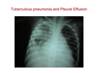 Tuberculous pneumonia and Pleural Effusion
 