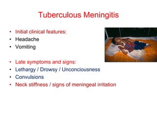 Tuberculous Meningitis
• Initial clinical features:
• Headache
• Vomiting
• Late symptoms and signs:
• Lethargy / Drowsy / Unconciousness
• Convulsions
• Neck stiffness / signs of meningeal irritation
 