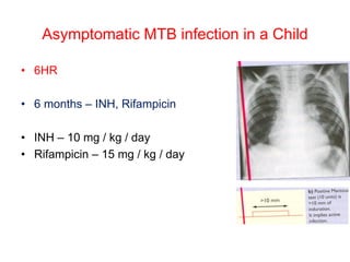 Asymptomatic MTB infection in a Child
• 6HR
• 6 months – INH, Rifampicin
• INH – 10 mg / kg / day
• Rifampicin – 15 mg / kg / day
 