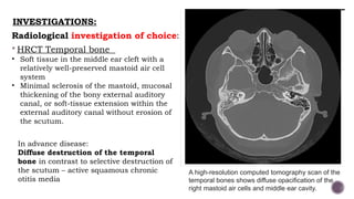 Scutum In Ear Tuberculosis in Otolaryngology power point.pptx