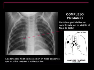 COMPLEJO
PRIMARIO
Linfadenopatía hiliar no
complicada, no es visible el
foco de Gohn
La adenopatía hiliar es mas común en niños pequeños
que en niños mayores o adolescentes.
 
