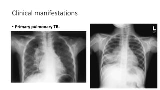 Clinical manifestations
• Primary pulmonary TB.
 