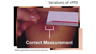 Variations of +PPD
Blisters, granulomas, local necrosis may occur
 