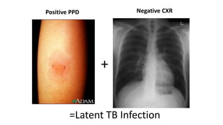 Positive PPD Negative CXR
+
=Latent TB Infection
 