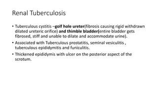 Renal Tuberculosis
• Tuberculous cystitis –golf hole ureter(fibrosis causing rigid withdrawn
dilated ureteric orifice) and thimble bladder(entire bladder gets
fibrosed, stiff and unable to dilate and accommodate urine).
• Associated with Tuberculous prostatitis, seminal vesiculitis ,
tuberculous epididymitis and funiculitis.
• Thickened epididymis with ulcer on the posterior aspect of the
scrotum.
 