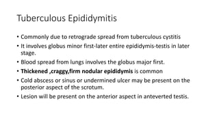 Tuberculous Epididymitis
• Commonly due to retrograde spread from tuberculous cystitis
• It involves globus minor first-later entire epididymis-testis in later
stage.
• Blood spread from lungs involves the globus major first.
• Thickened ,craggy,firm nodular epididymis is common
• Cold abscess or sinus or undermined ulcer may be present on the
posterior aspect of the scrotum.
• Lesion will be present on the anterior aspect in anteverted testis.
 