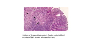 tuberculosis in surgery for under graduates .pptx