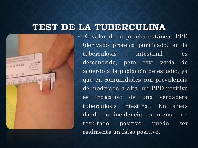 ¿Qué Es Una Prueba Positiva De Tuberculosis – GPZMFP