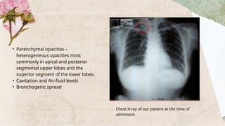 Heterogeneous Opacity Tuberculosis kogi copy.pptxgfhnfgbftyrtghbcxt | PPTX
