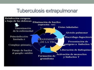 Tuberculosis extrapulmonar
 